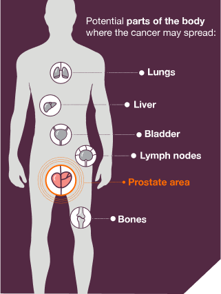 Potential parts of the body where the cancer may spread beyond the prostate area (lungs, liver, bladder, lymph nodes, bones)