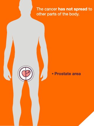 The cancer has not spread to other parts of the body beyond the prostate area